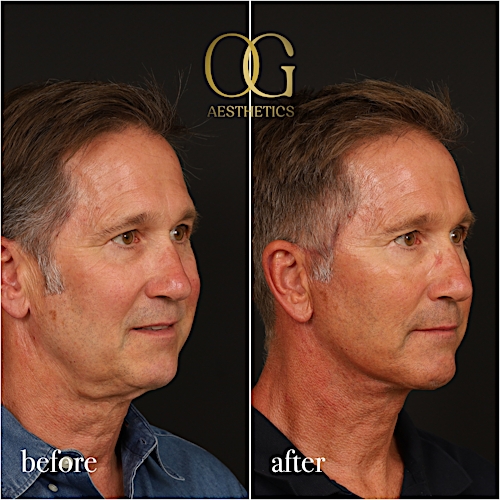 Neck Lift Before & After Gallery - Patient 245267 - Image 3
