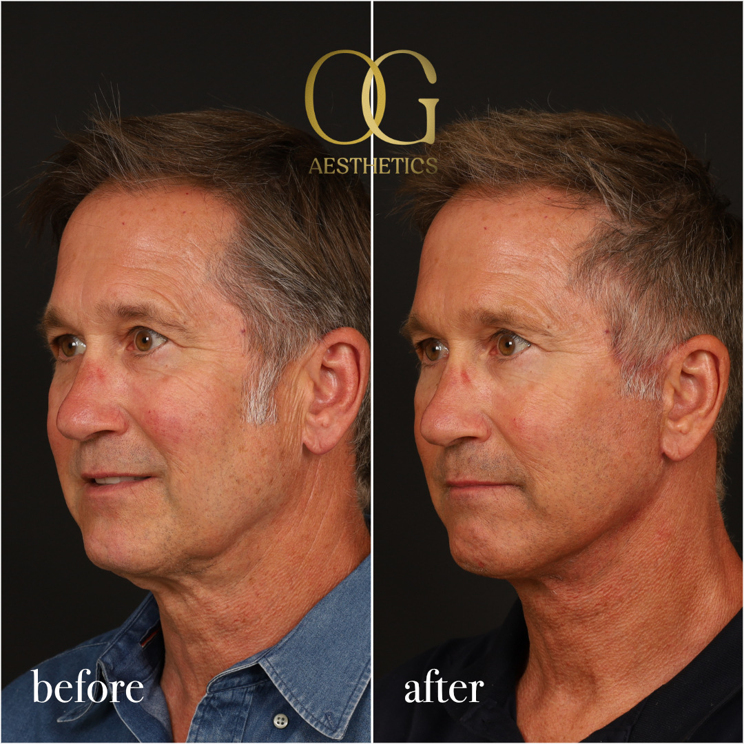 Neck Lift Before & After Gallery - Patient 245267 - Image 5