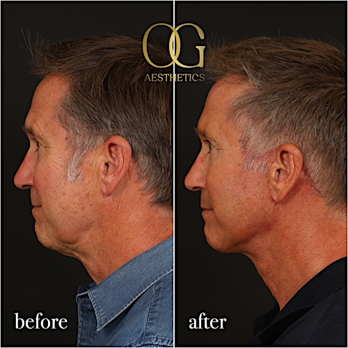 Facelift Before & After Gallery - Patient 190629140 - Image 6