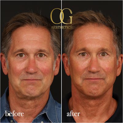 Facelift Before & After Gallery - Patient 190629140 - Image 1