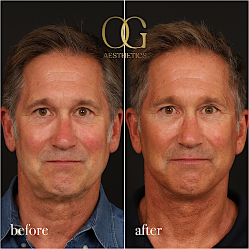 Neck Lift Before & After Gallery - Patient 245267 - Image 1