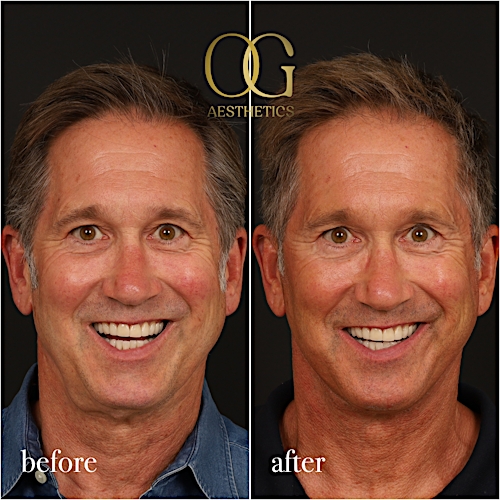 Neck Lift Before & After Gallery - Patient 245267 - Image 2