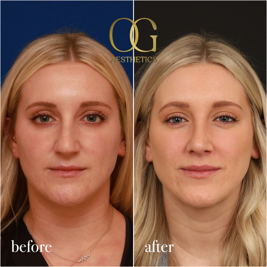 Rhinoplasty Before & After Gallery - Patient 190629151 - Image 3