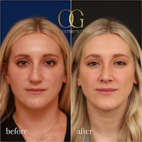 Rhinoplasty Before & After Gallery - Patient 190629151 - Image 3