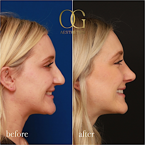Rhinoplasty Before & After Gallery - Patient 190629151 - Image 4