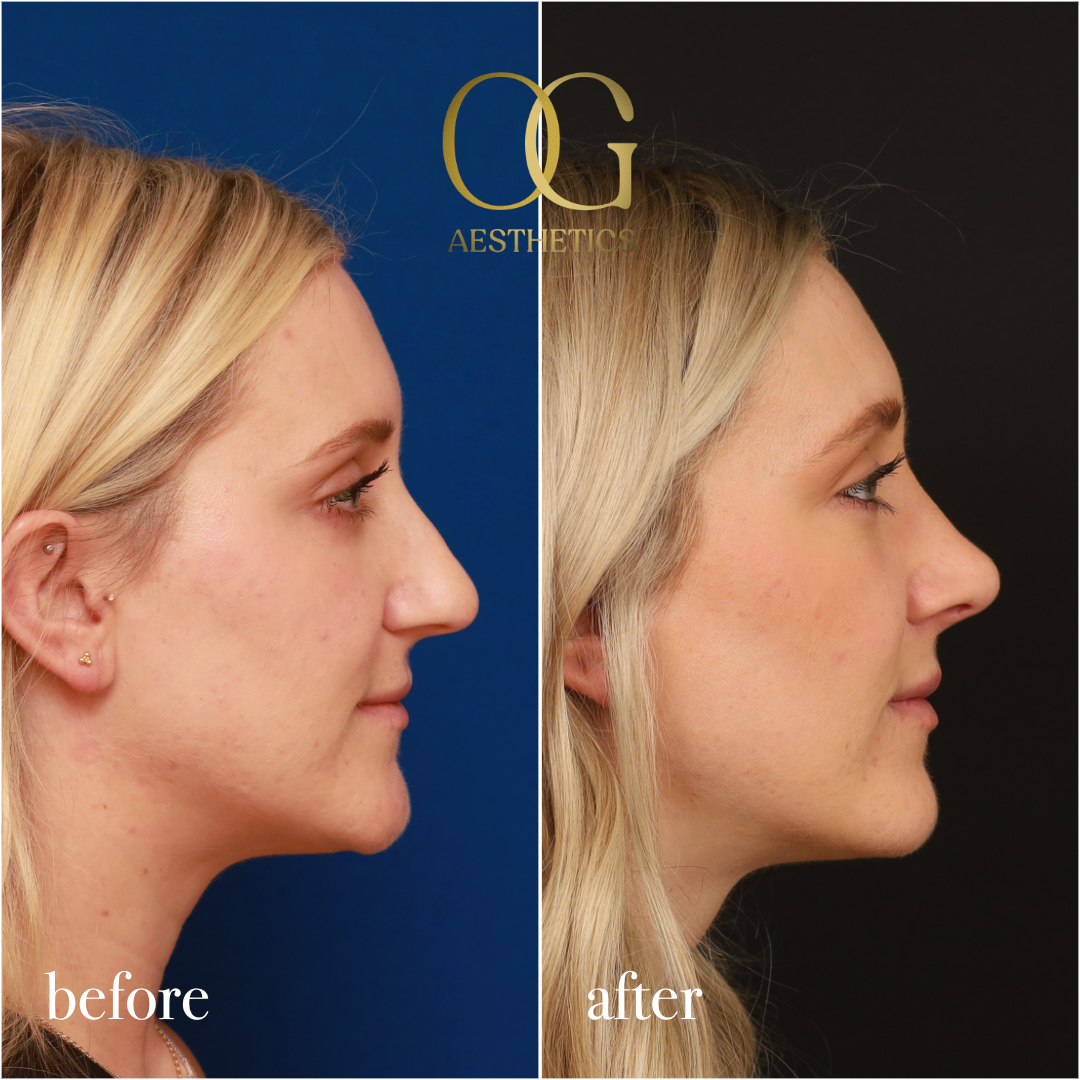 Rhinoplasty Before & After Gallery - Patient 190629151 - Image 5