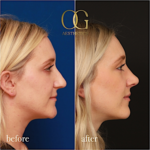 Rhinoplasty Before & After Gallery - Patient 190629151 - Image 5