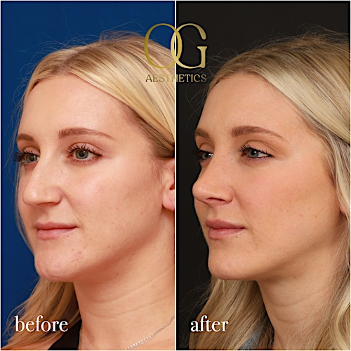 Rhinoplasty Before & After Gallery - Patient 190629151 - Image 6