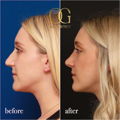 Rhinoplasty Before & After Gallery - Patient 190629151 - Image 1