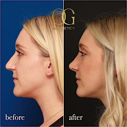 Rhinoplasty Before & After Gallery - Patient 190629151 - Image 1