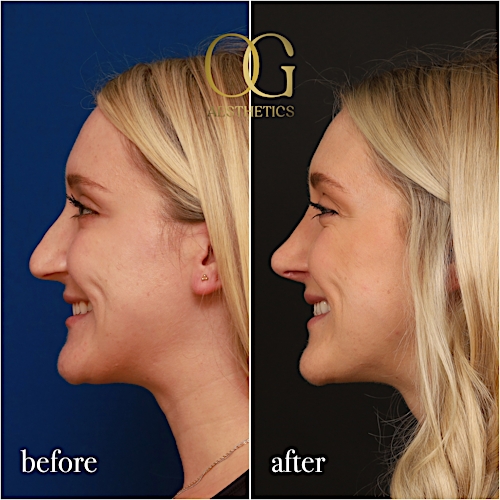 Rhinoplasty Before & After Gallery - Patient 190629151 - Image 2