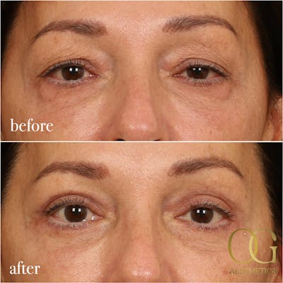 Blepharoplasty Before & After Gallery - Patient 190629153 - Image 1
