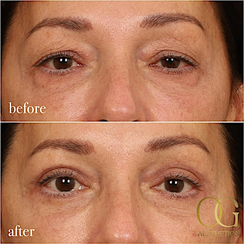 Blepharoplasty Before & After Gallery - Patient 190629153 - Image 1