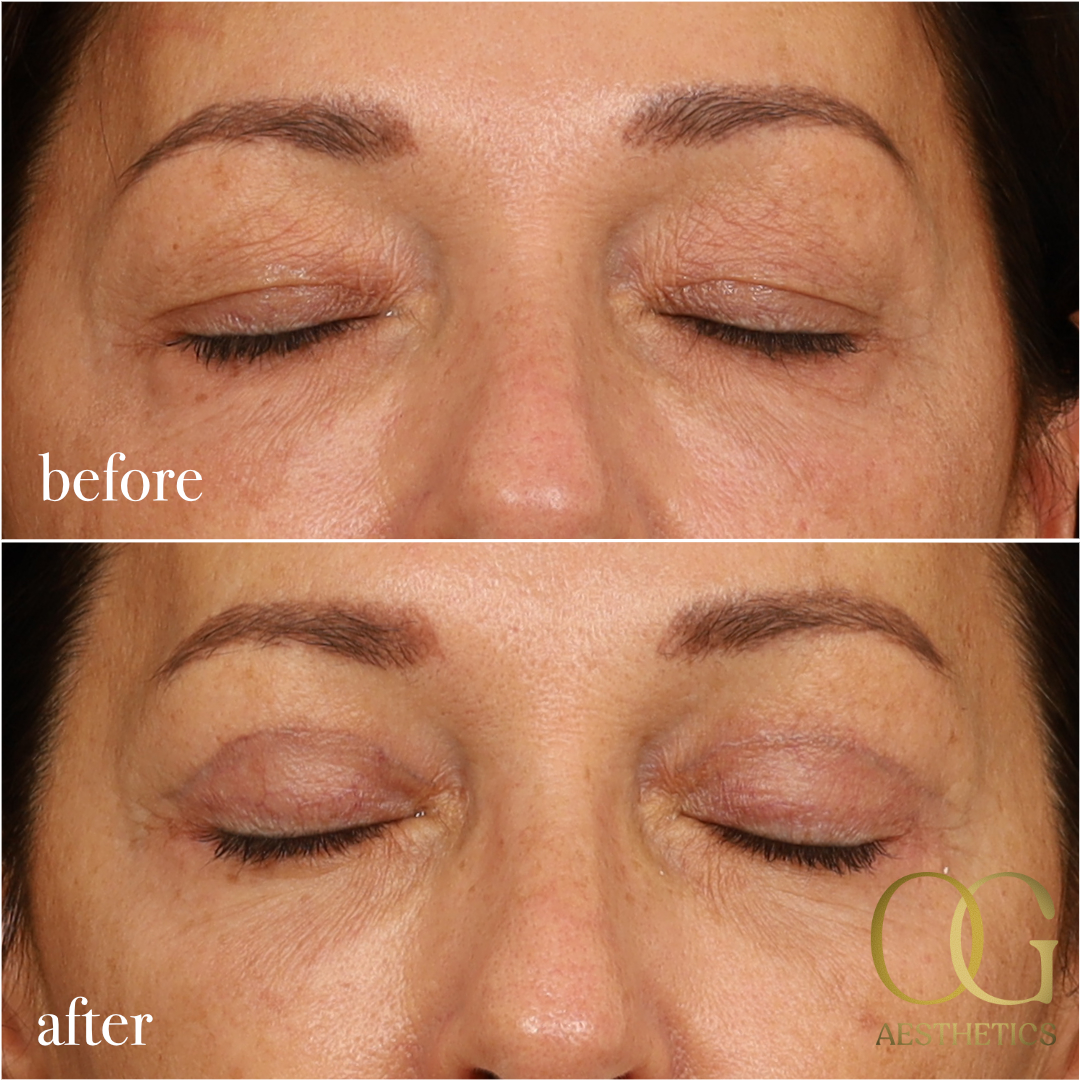Blepharoplasty Before & After Gallery - Patient 190629153 - Image 2