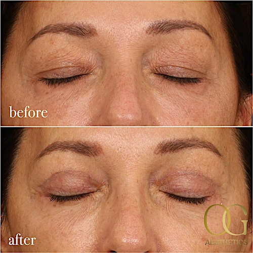 Blepharoplasty Before & After Gallery - Patient 190629153 - Image 2