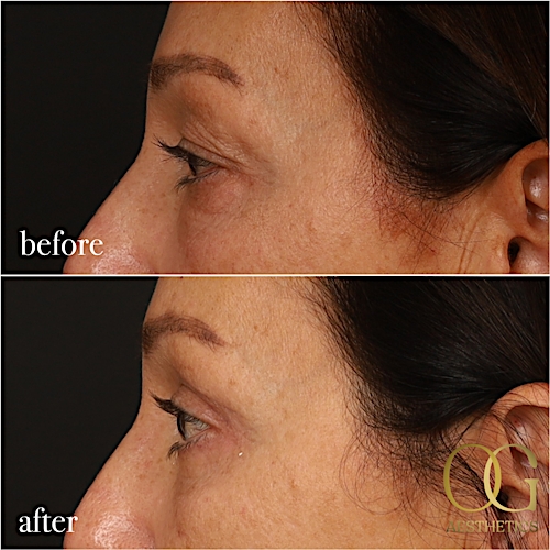 Blepharoplasty Before & After Gallery - Patient 190629153 - Image 4