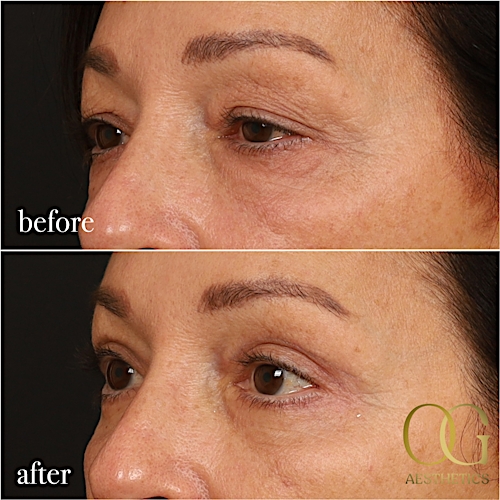 Blepharoplasty Before & After Gallery - Patient 190629153 - Image 3