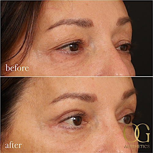 Blepharoplasty Before & After Gallery - Patient 190629153 - Image 5