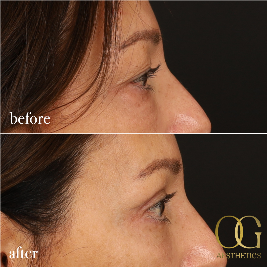 Blepharoplasty Before & After Gallery - Patient 190629153 - Image 6