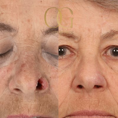Facial Reconstruction Before & After Gallery - Patient 191975319 - Image 1