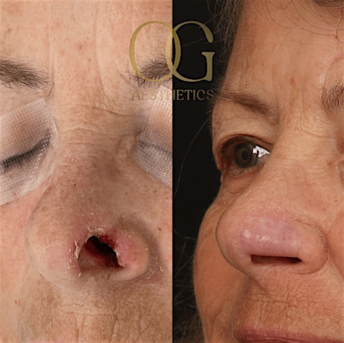 Facial Reconstruction Before & After Gallery - Patient 191975319 - Image 3
