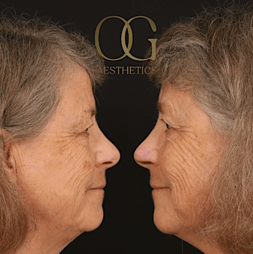 Facial Reconstruction Before & After Gallery - Patient 191975319 - Image 4