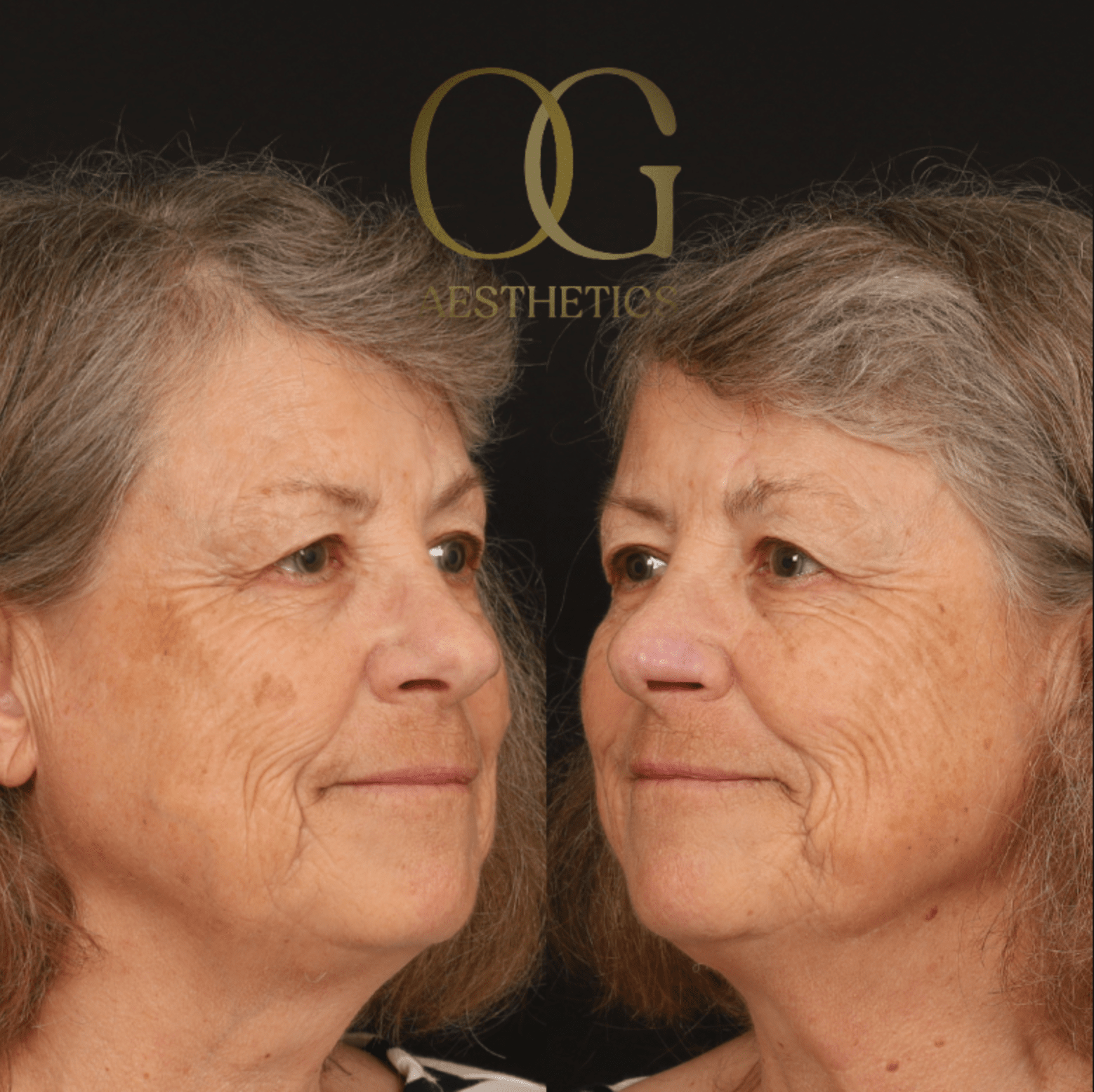 Facial Reconstruction Before & After Gallery - Patient 191975319 - Image 5