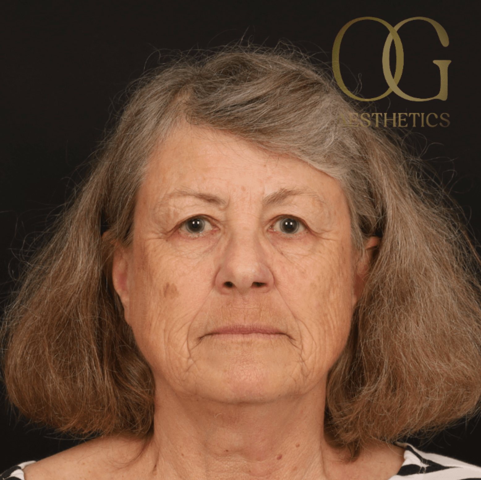 Facial Reconstruction Before & After Gallery - Patient 191975319 - Image 6