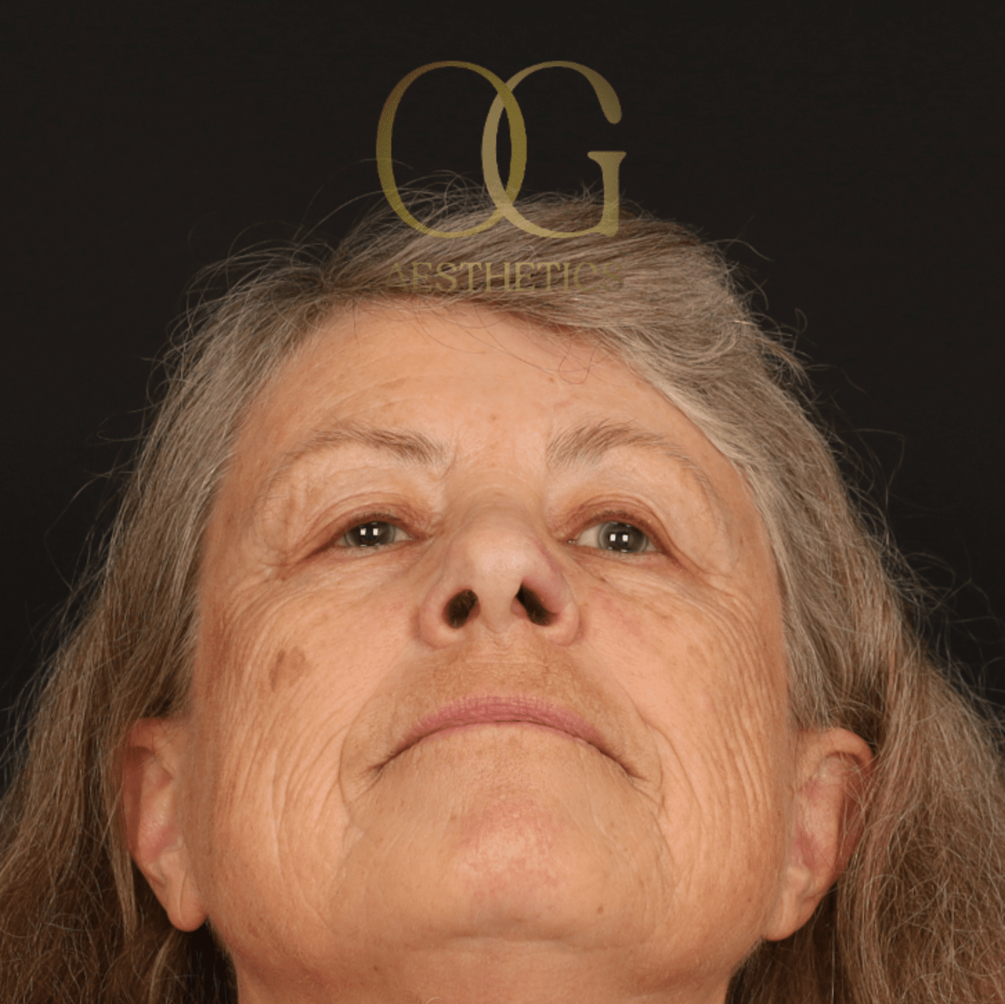 Facial Reconstruction Before & After Gallery - Patient 191975319 - Image 7