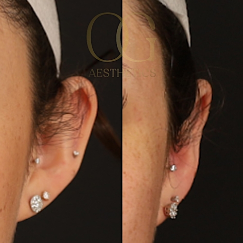 Otoplasty Before & After Gallery - Patient 191975327 - Image 1