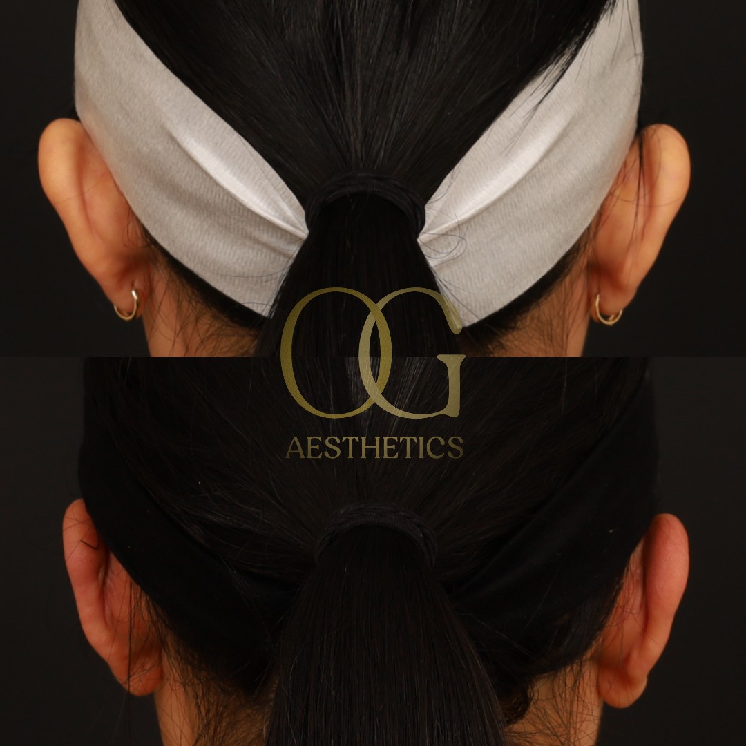 Otoplasty Before & After Gallery - Patient 191975328 - Image 2