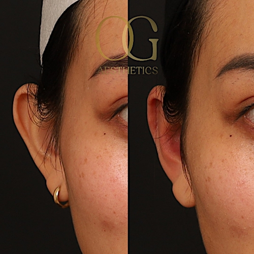 Otoplasty Before & After Gallery - Patient 191975328 - Image 3