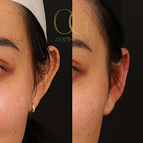 Otoplasty Before & After Gallery - Patient 191975328 - Image 1