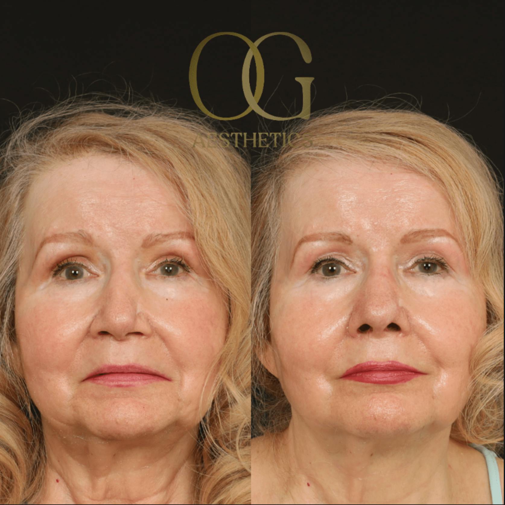 Rhinoplasty Before & After Gallery - Patient 191975407 - Image 3