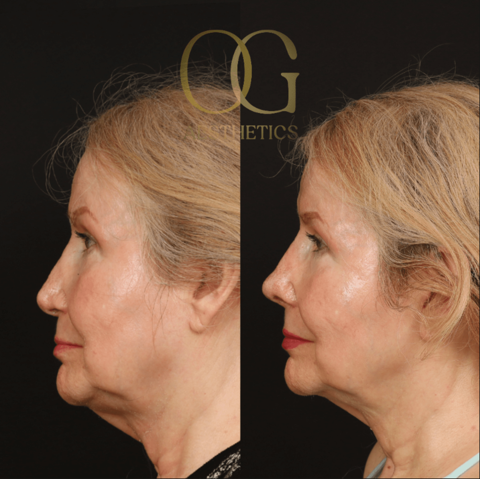 Rhinoplasty Before & After Gallery - Patient 191975407 - Image 1