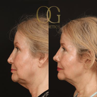 Rhinoplasty Before & After Gallery - Patient 191975407 - Image 1