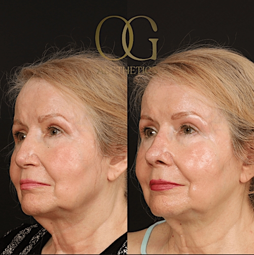 Rhinoplasty Before & After Gallery - Patient 191975407 - Image 2