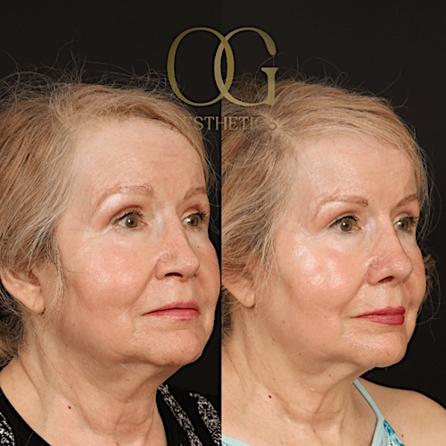 Rhinoplasty Before & After Gallery - Patient 191975407 - Image 4