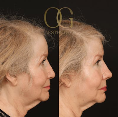 Revision Rhinoplasty Before & After Gallery - Patient 194520651 - Image 1