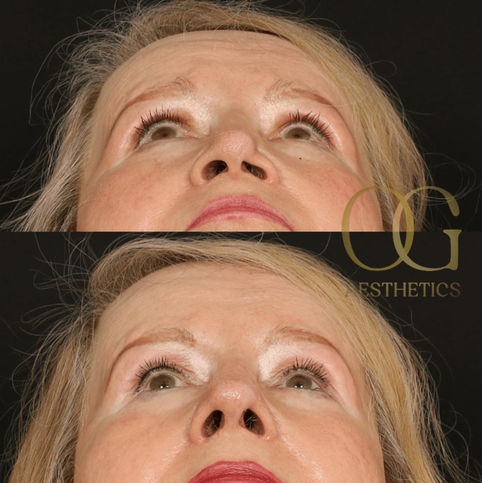 Rhinoplasty Before & After Gallery - Patient 191975407 - Image 6