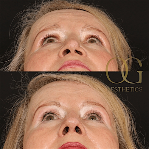 Rhinoplasty Before & After Gallery - Patient 191975407 - Image 6