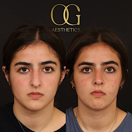 Rhinoplasty Before & After Gallery - Patient 191975406 - Image 3