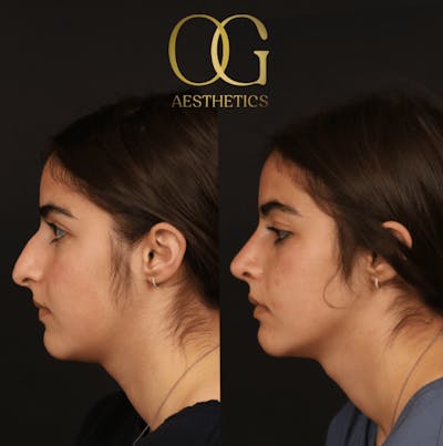 Rhinoplasty Before & After Gallery - Patient 191975406 - Image 1