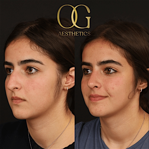 Rhinoplasty Before & After Gallery - Patient 191975406 - Image 2