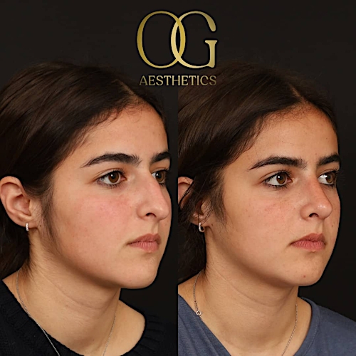 Rhinoplasty Before & After Gallery - Patient 191975406 - Image 4