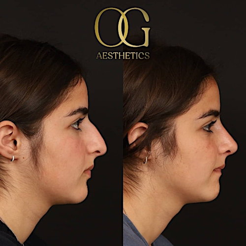 Rhinoplasty Before & After Gallery - Patient 191975406 - Image 5