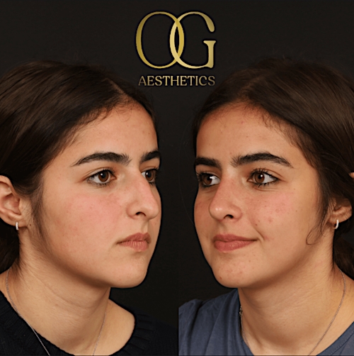 Rhinoplasty Before & After Gallery - Patient 191975406 - Image 6