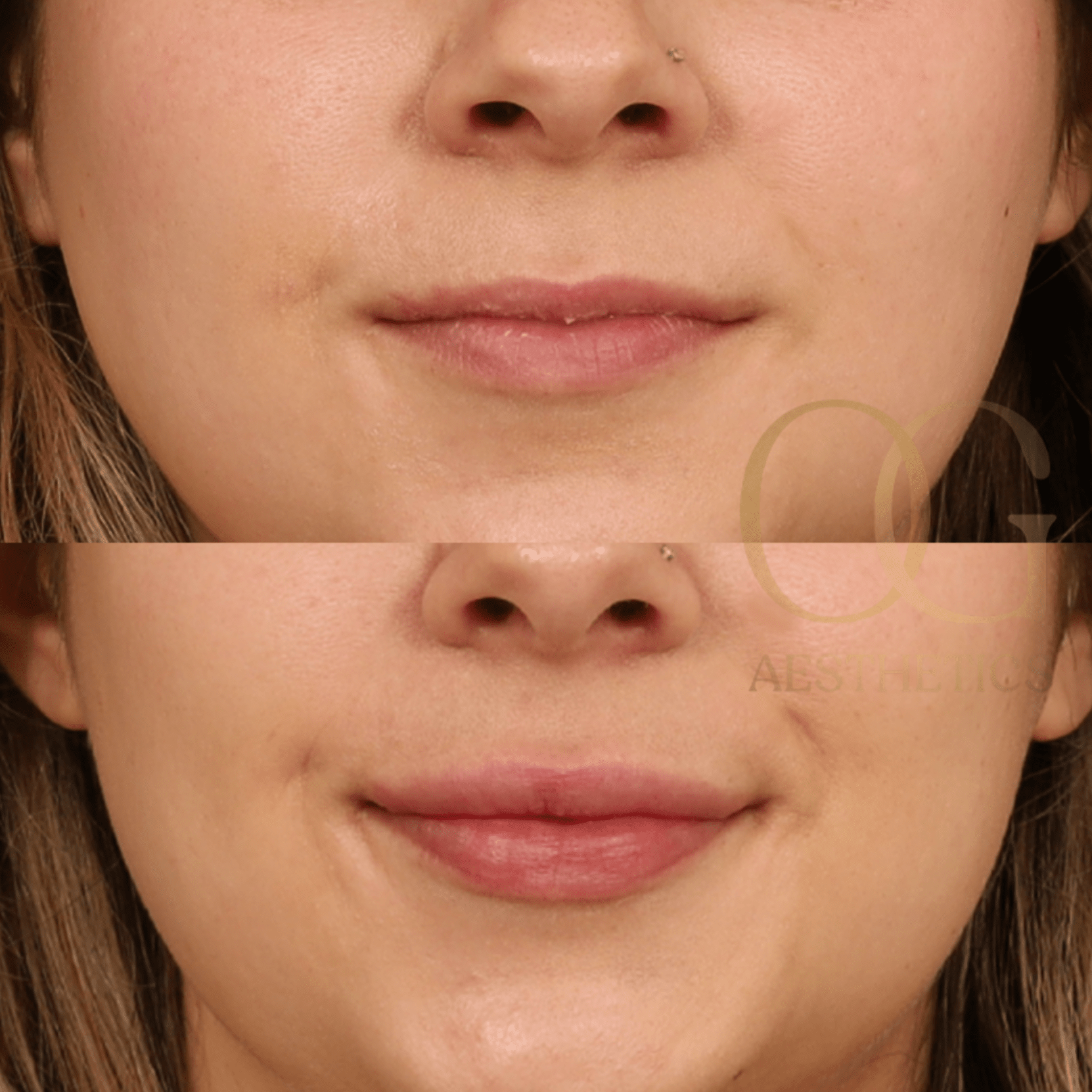 Lip Fillers Before & After Gallery - Patient 194520653 - Image 1