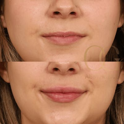 Lip Fillers Before & After Gallery - Patient 194520653 - Image 1