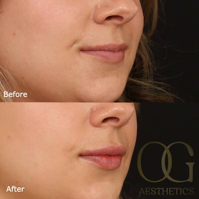 Lip Fillers Before & After Gallery - Patient 194520666 - Image 1